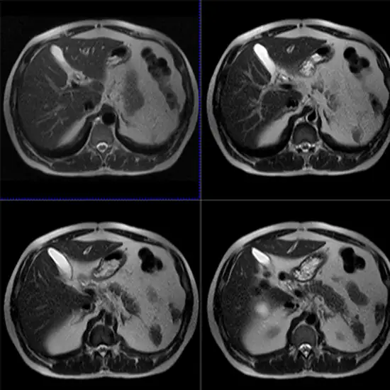 MRI Upper Abdomen With Contrast